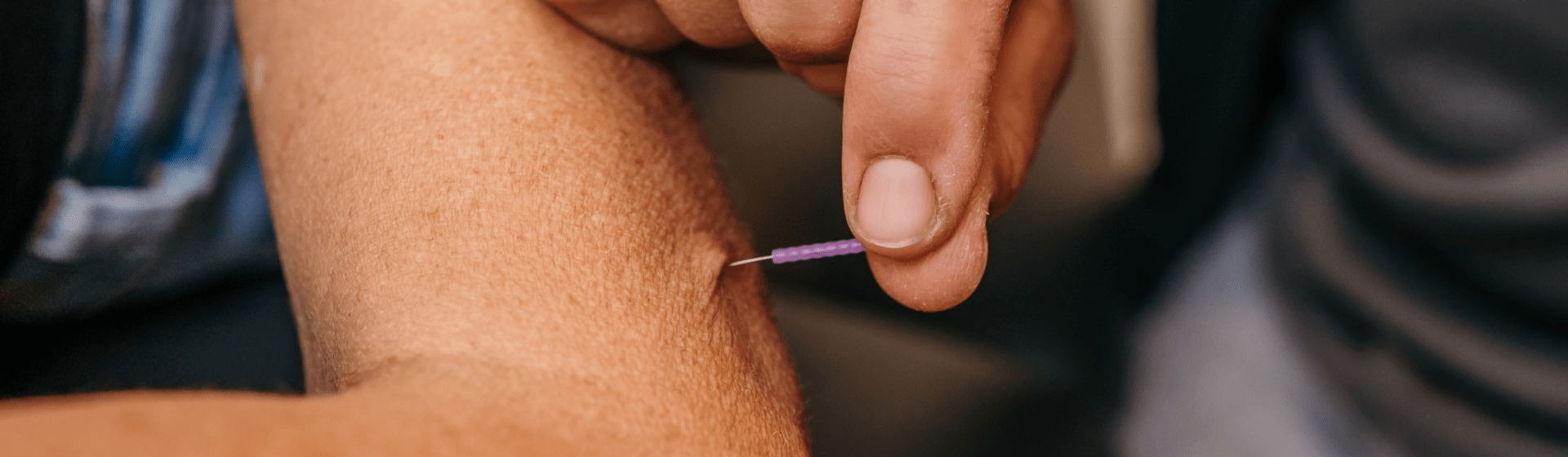 Dry needling